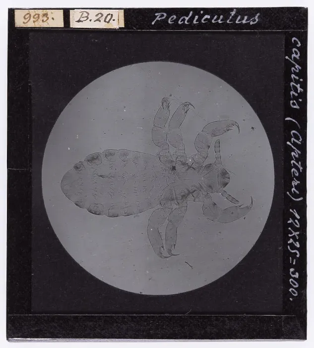 Stampa con cornice : Pediculus Capitis (Apteri) ingrandito al microscopio