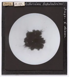Microfotografia Stampe: Achorion Schoenleinii. Fungo parassita dell'uomo, ingrandito al microscopio